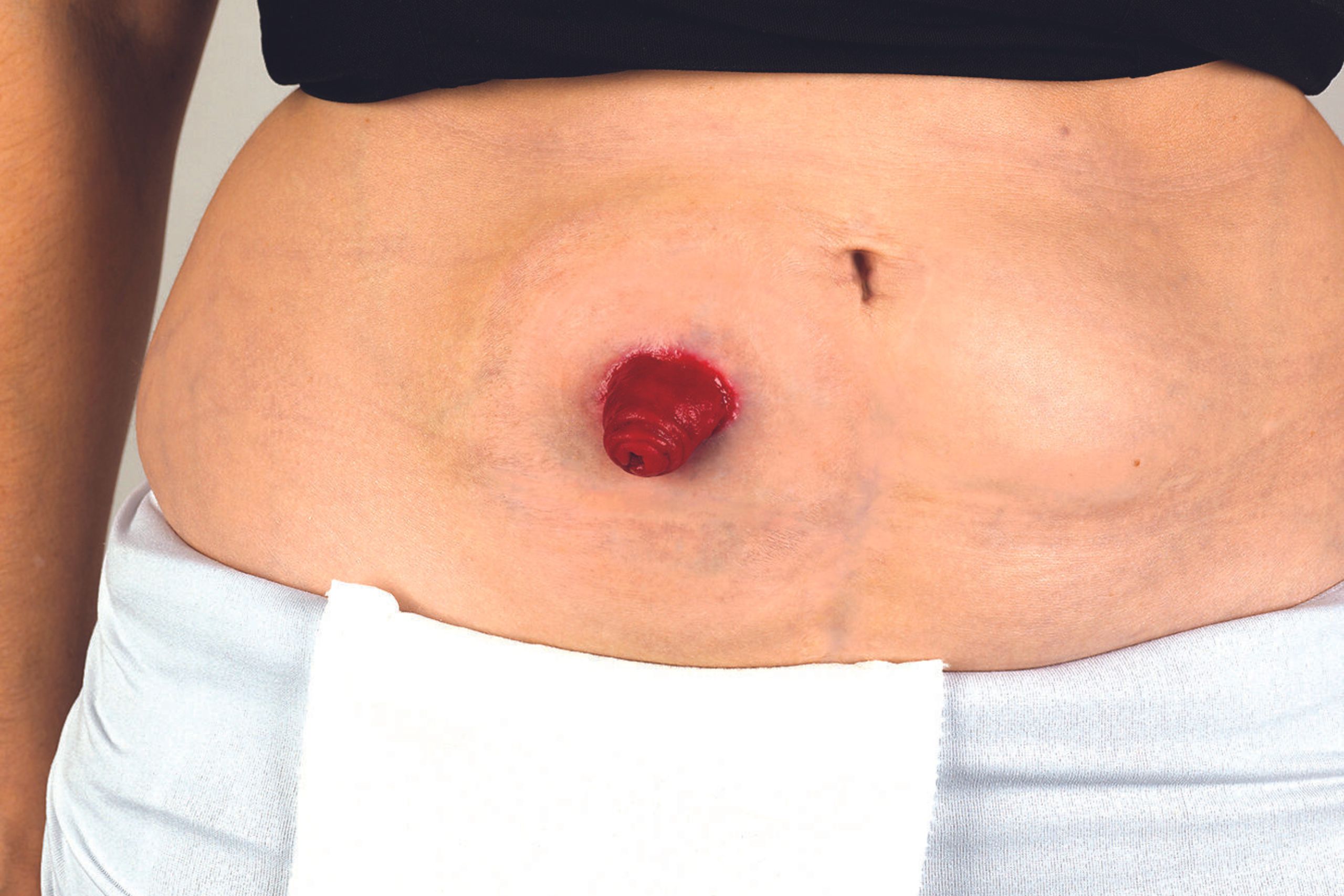 This is a photo of a healthy stoma. It is the header image for a page on the Urostomy Association's website entitled 'Early days following surgery'