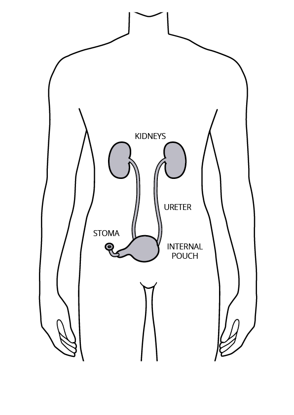 This is a graphic showing an internal pouch. It show how the kidneys are connected, via the ureters to a newly created continent urinary diversion 